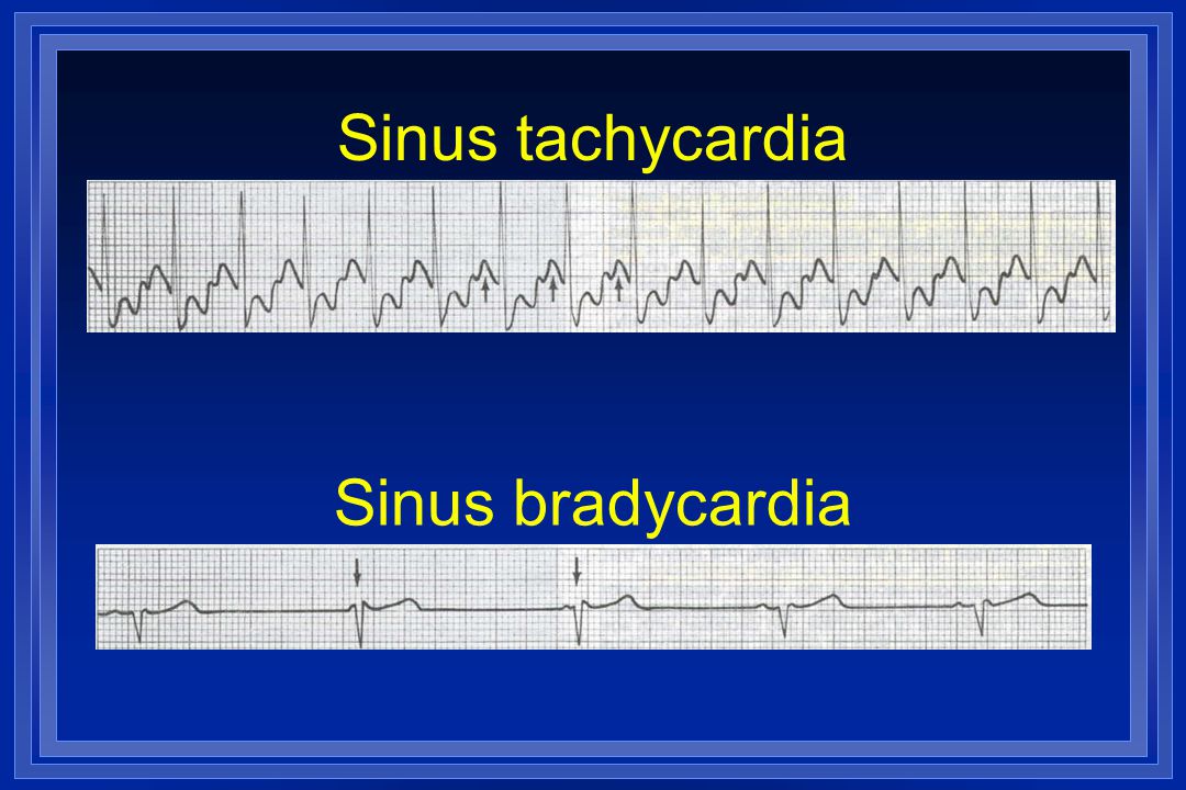 Sinus tachycardia Sinus bradycardia