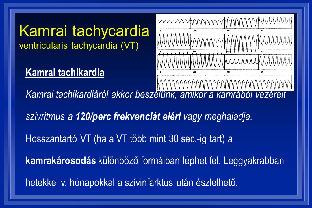 Kamrai tachycardia ventricularis tachycardia (VT)