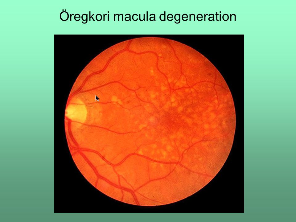 Öregkori macula degeneration