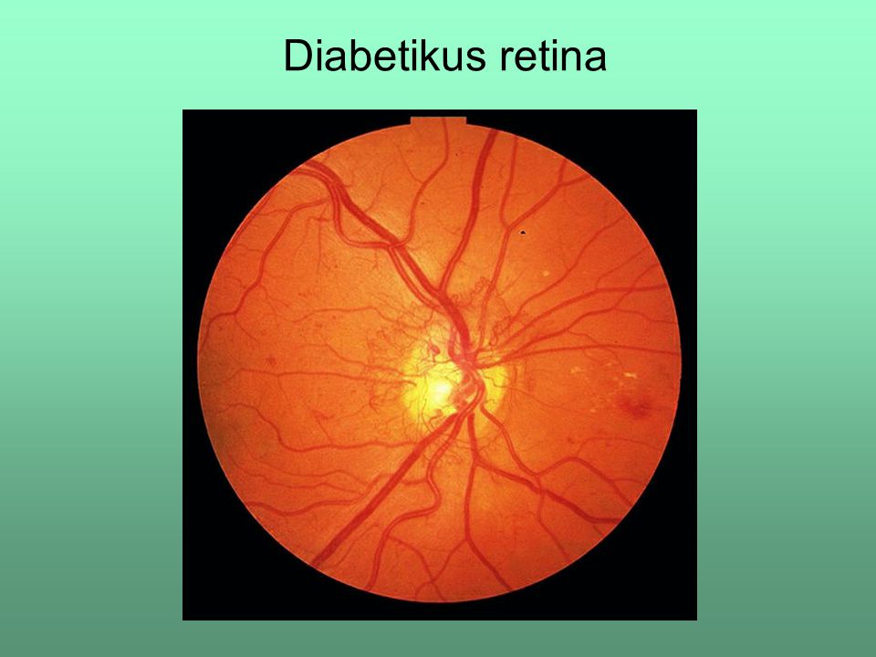 Diabetikus retina
