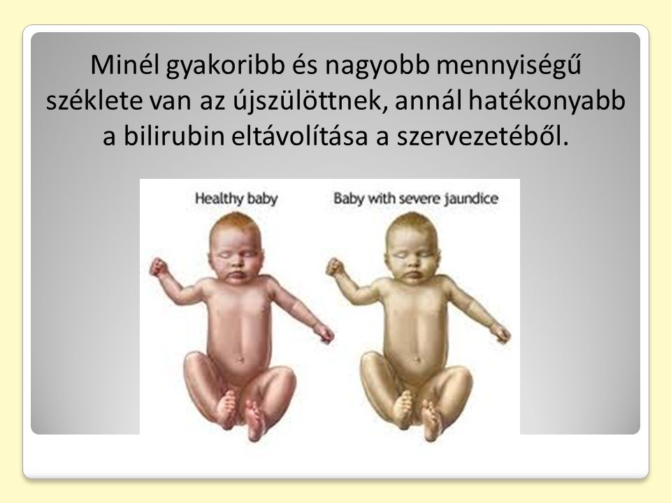 Minél gyakoribb és nagyobb mennyiségű széklete van az újszülöttnek, annál hatékonyabb a bilirubin eltávolítása a szervezetéből.
