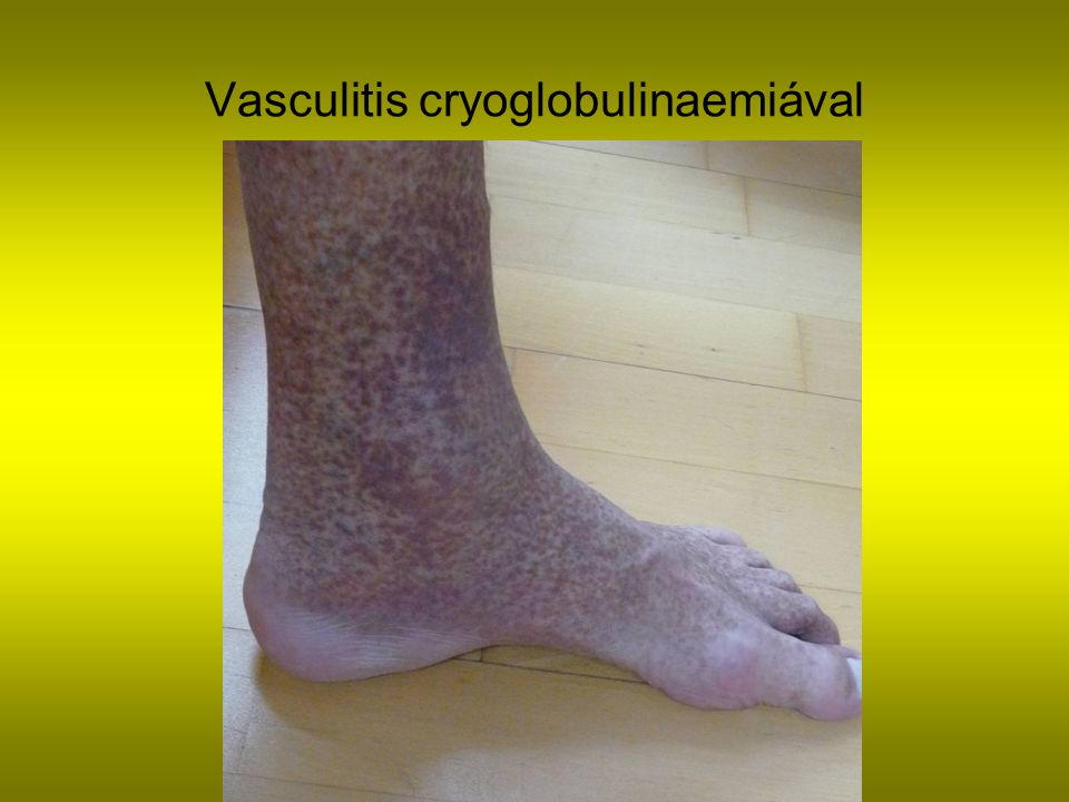 Vasculitis cryoglobulinaemiával