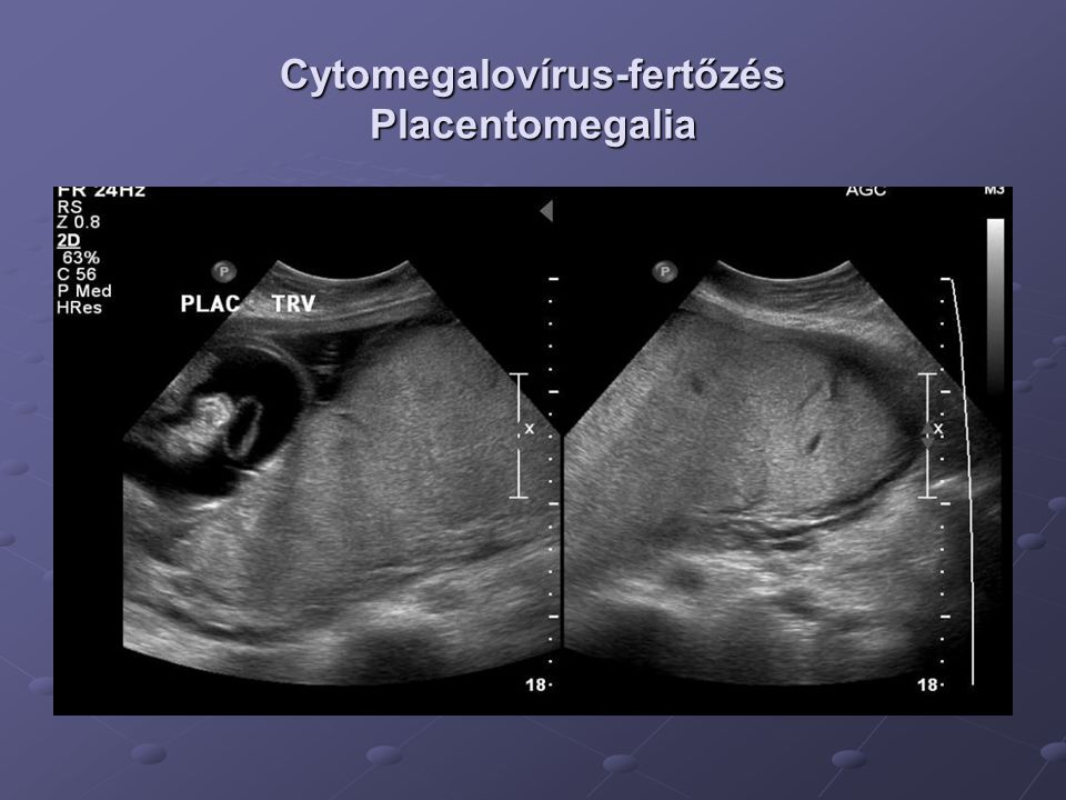 Cytomegalovírus-fertőzés Placentomegalia