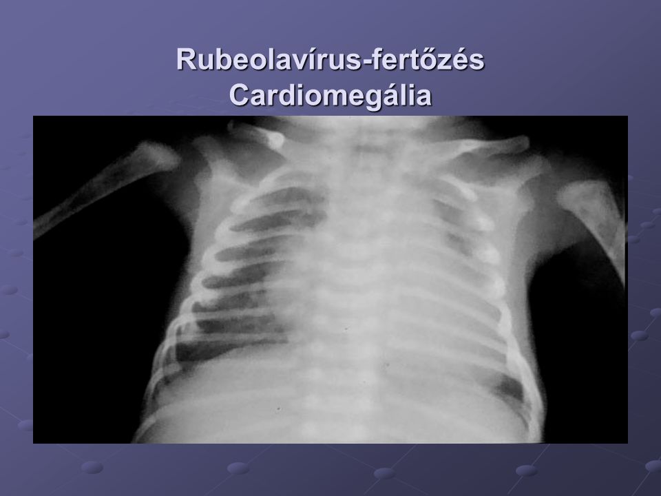 Rubeolavírus-fertőzés Cardiomegália