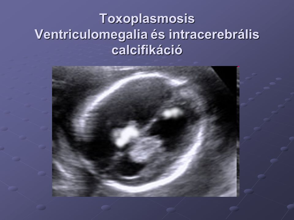 Toxoplasmosis Ventriculomegalia és intracerebrális calcifikáció