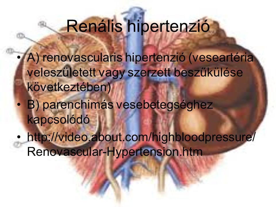 Renális hipertenzió A) renovascularis hipertenzió (veseartéria veleszületett vagy szerzett beszűkülése következtében)