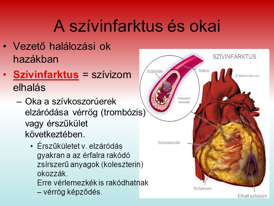 A szívinfarktus és okai