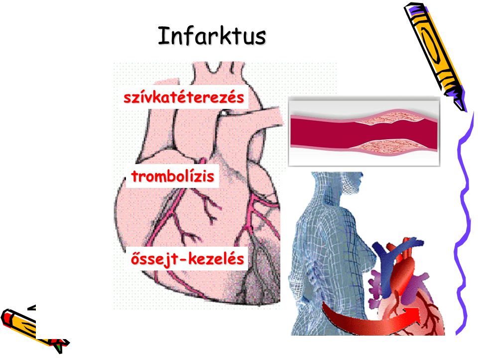 Infarktus szívkatéterezés trombolízis őssejt-kezelés