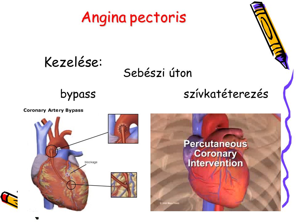Angina pectoris Kezelése: Sebészi úton bypass szívkatéterezés