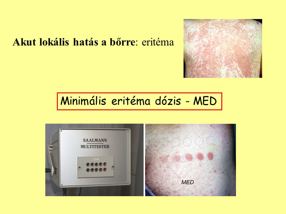 Akut lokális hatás a bőrre: eritéma