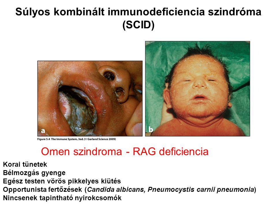 Súlyos kombinált immunodeficiencia szindróma (SCID)
