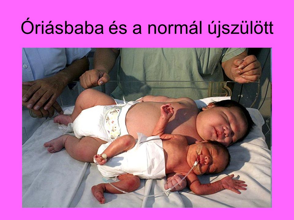 Óriásbaba és a normál újszülött