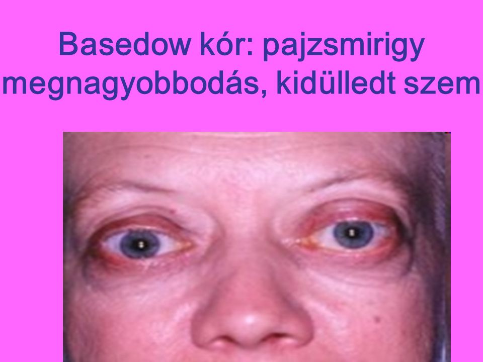 Basedow kór: pajzsmirigy megnagyobbodás, kidülledt szem