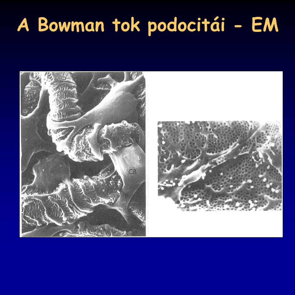 A Bowman tok podocitái - EM