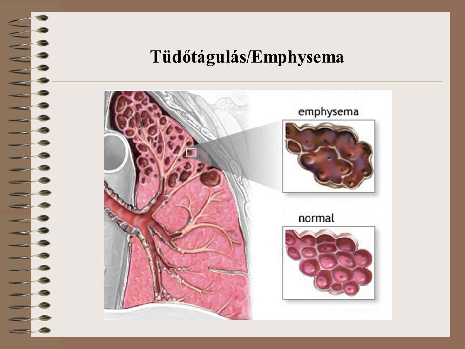 Tüdőtágulás/Emphysema
