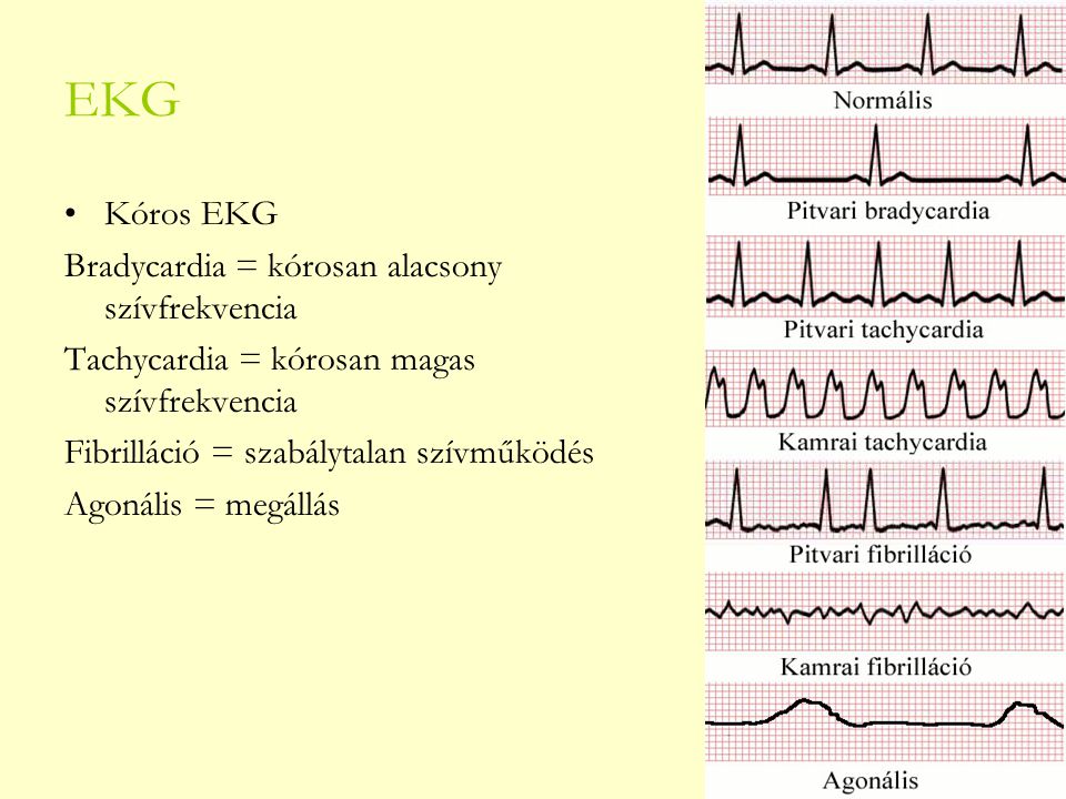 EKG Kóros EKG Bradycardia = kórosan alacsony szívfrekvencia