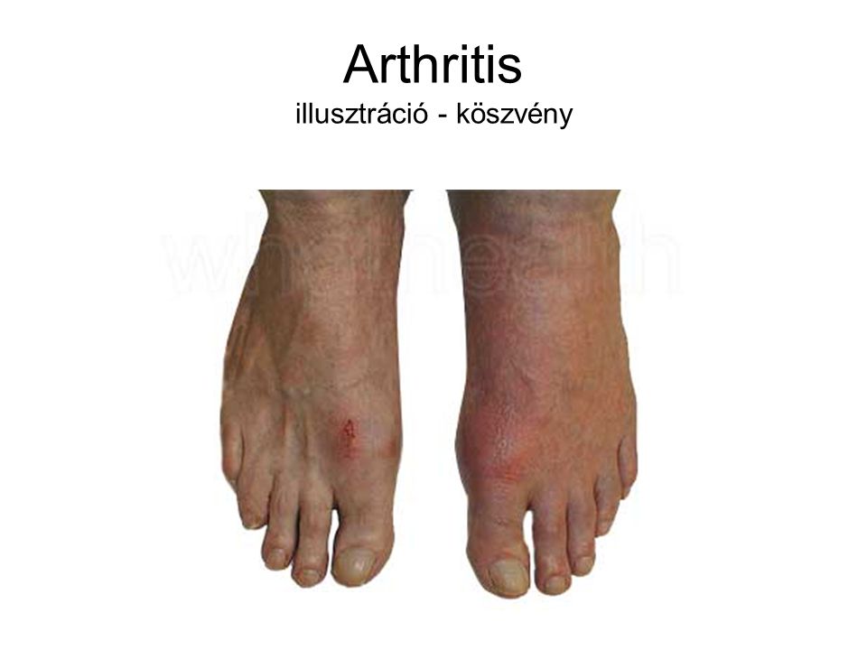 Arthritis illusztráció - köszvény