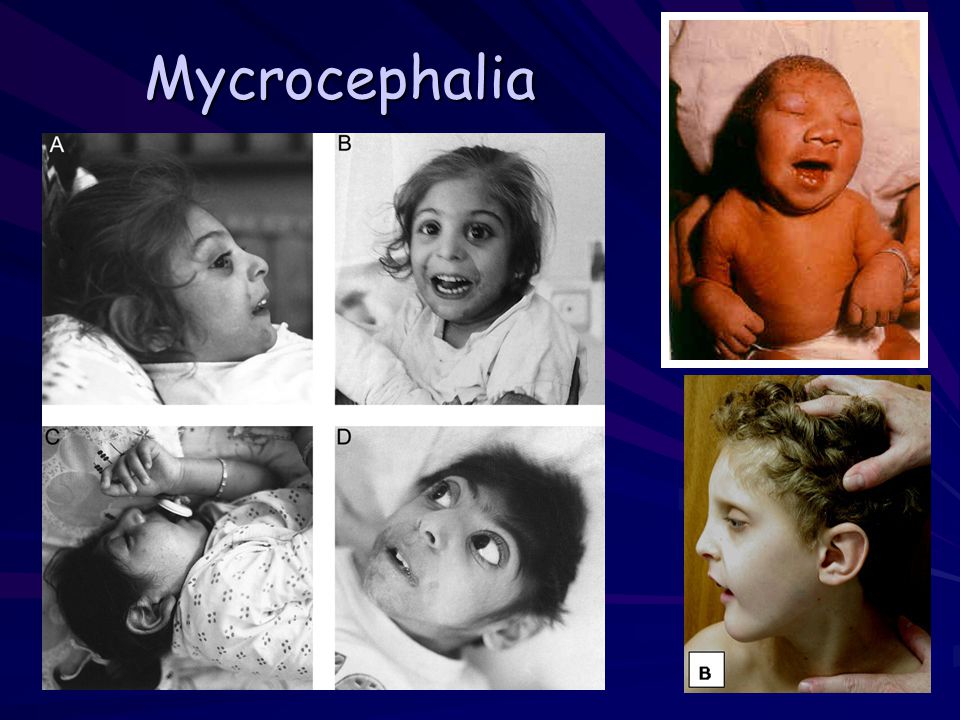 Mycrocephalia