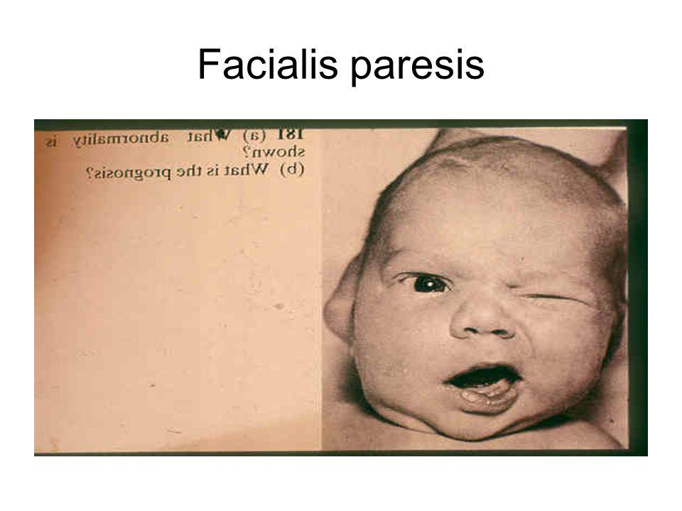 Facialis paresis