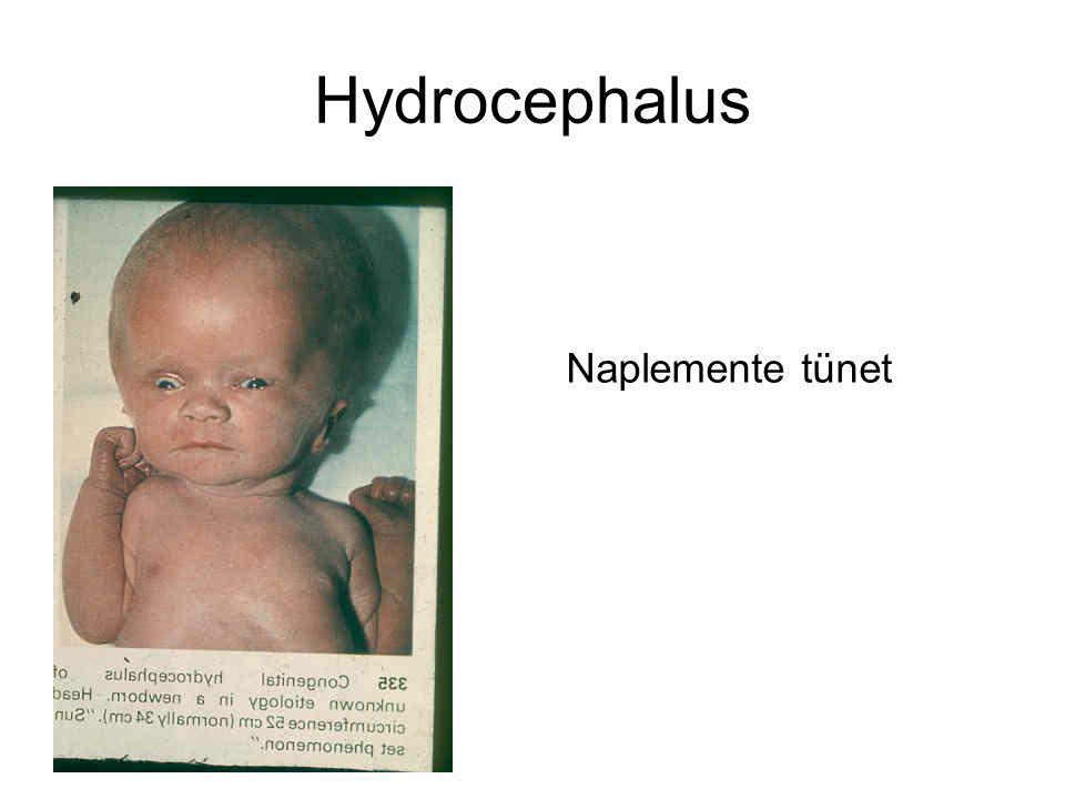Hydrocephalus Naplemente tünet