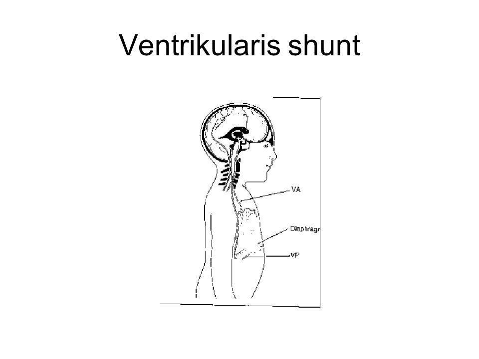 Ventrikularis shunt
