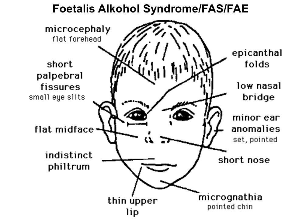 Foetalis Alkohol Syndrome/FAS/FAE