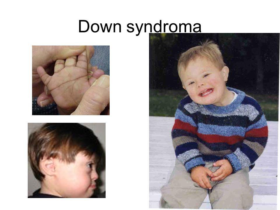 Down syndroma