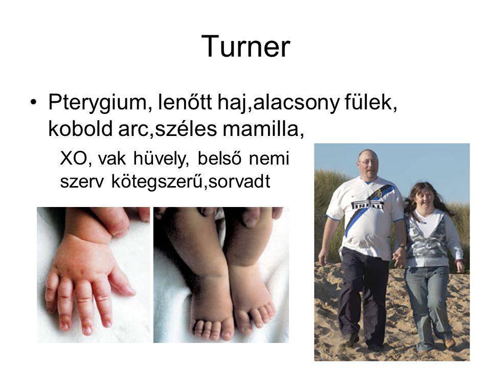 Turner Pterygium, lenőtt haj,alacsony fülek, kobold arc,széles mamilla, XO, vak hüvely, belső nemi.