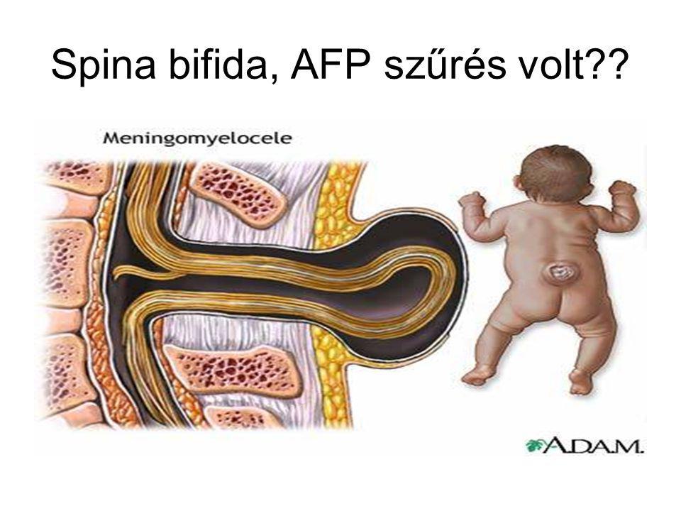 Spina bifida, AFP szűrés volt