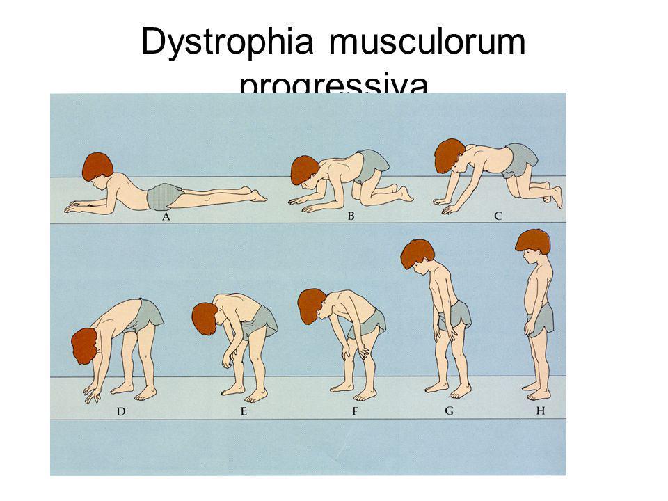 Dystrophia musculorum progressiva