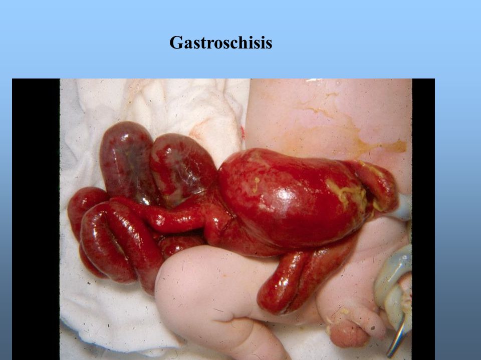 Gastroschisis