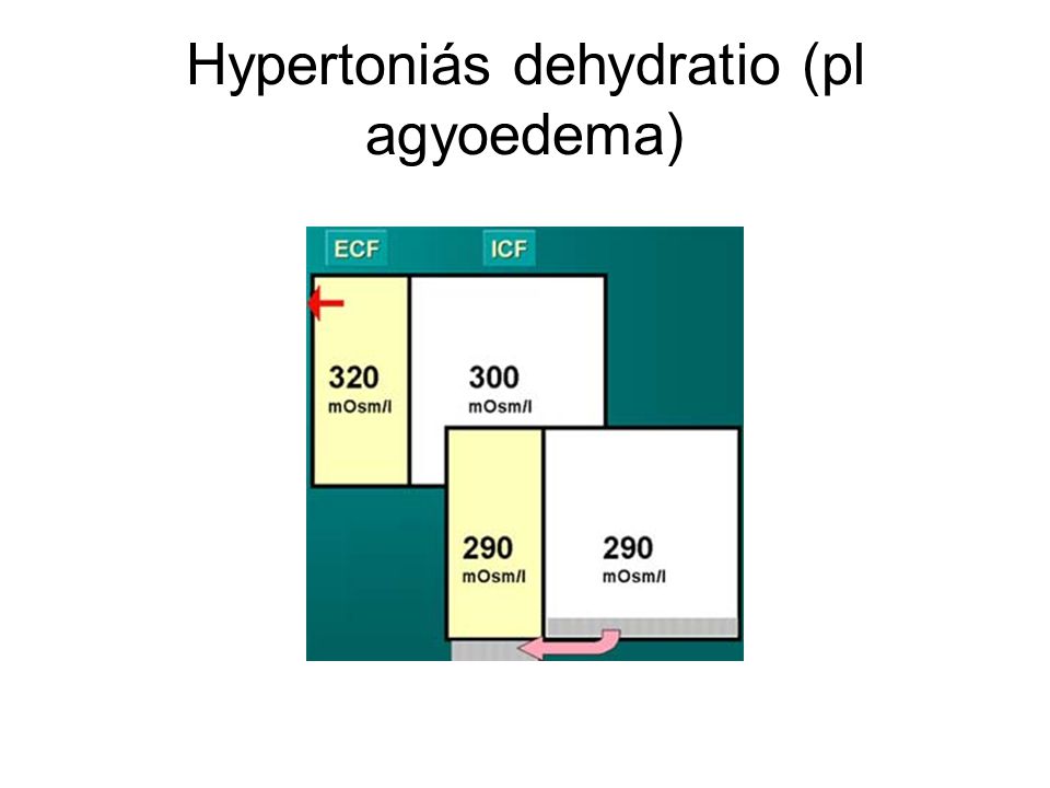 Hypertoniás dehydratio (pl agyoedema)