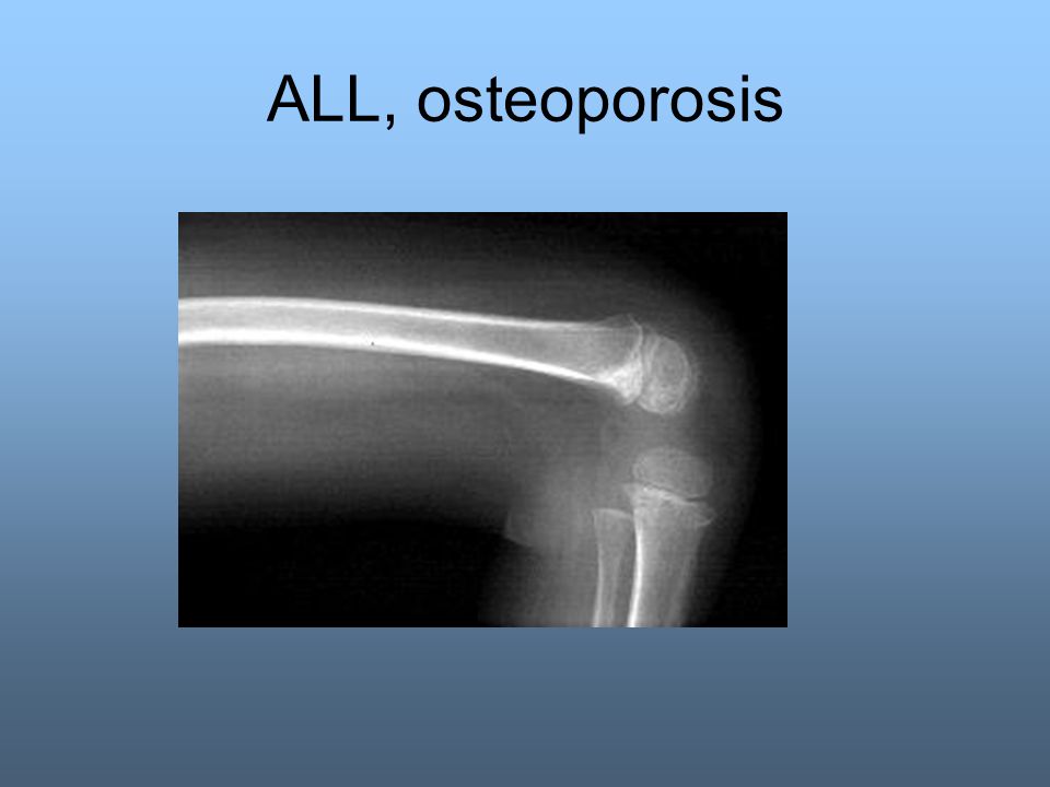 ALL, osteoporosis
