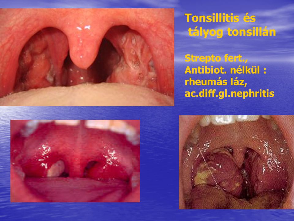 Tonsillitis és tályog tonsillán Strepto fert., Antibiot. nélkül :