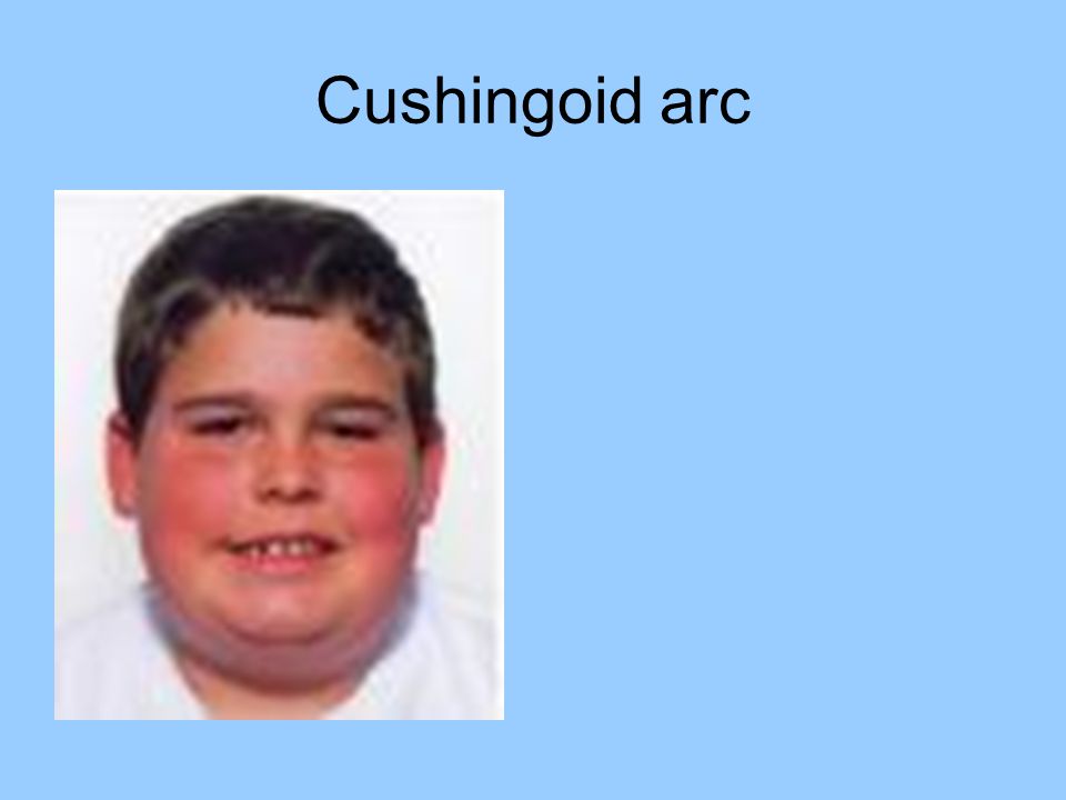 Cushingoid arc