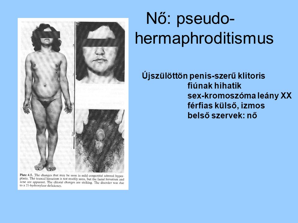 Nő: pseudo- hermaphroditismus