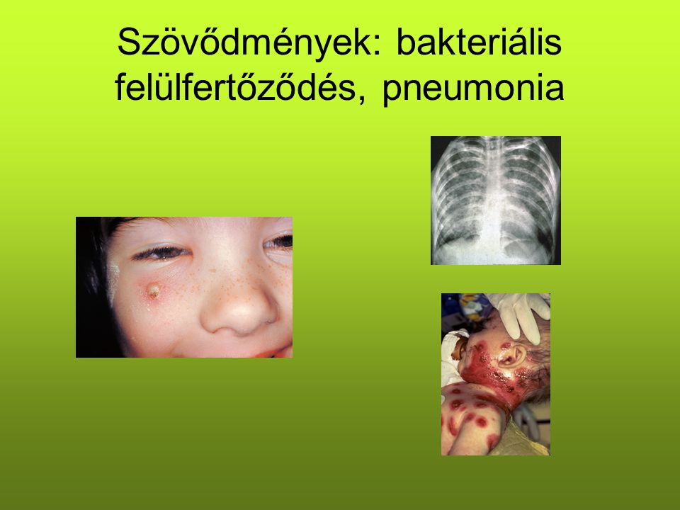 Szövődmények: bakteriális felülfertőződés, pneumonia
