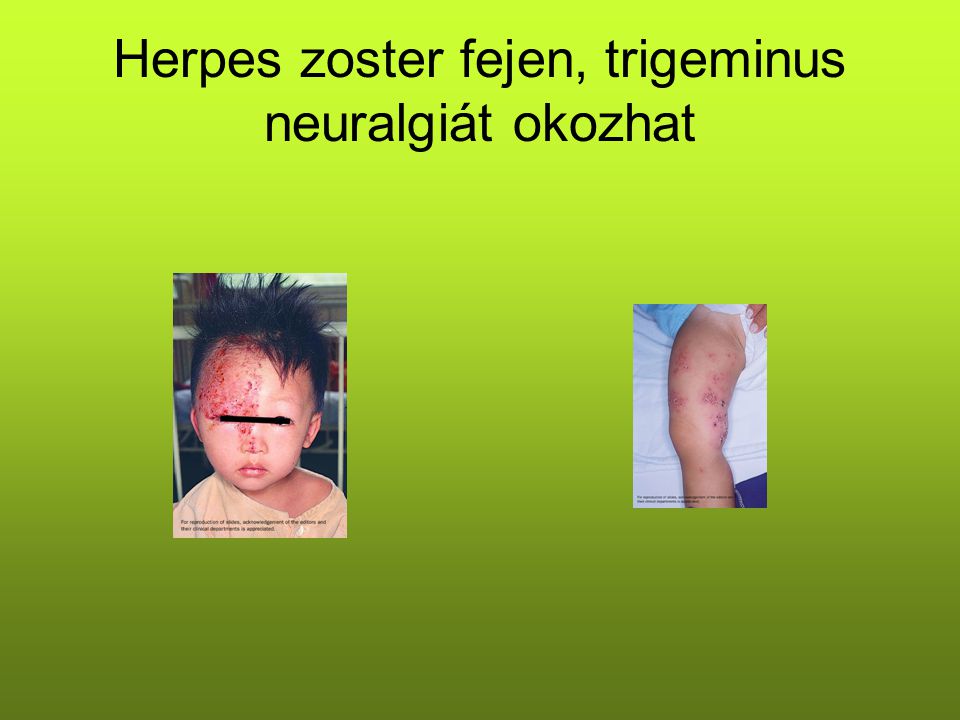 Herpes zoster fejen, trigeminus neuralgiát okozhat