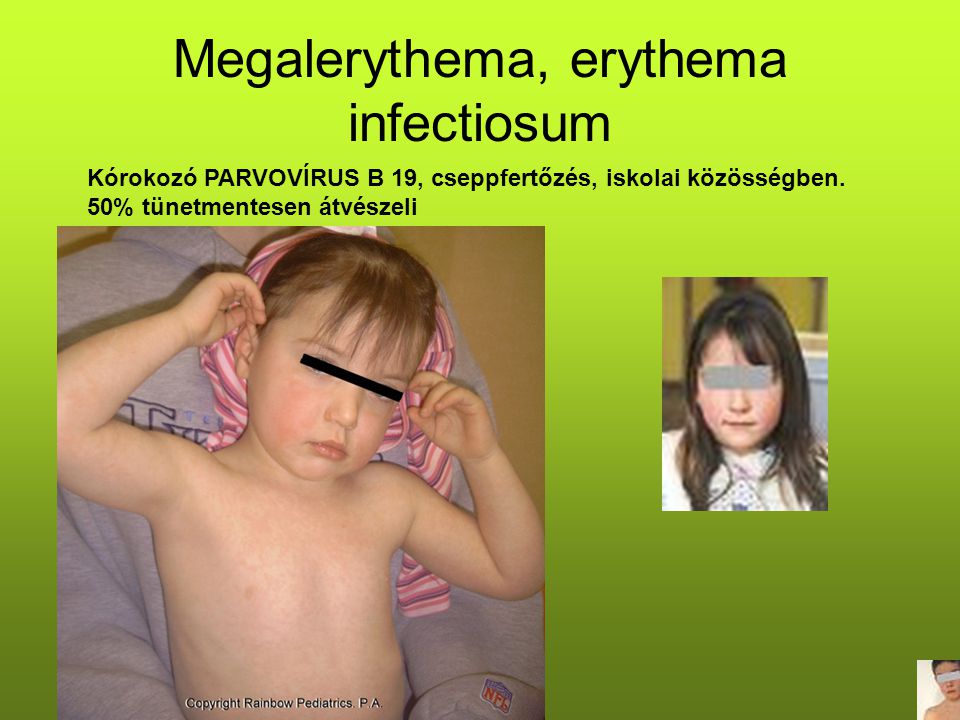 Megalerythema, erythema infectiosum