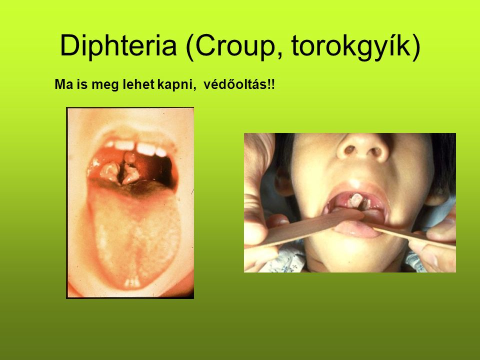 Diphteria (Croup, torokgyík)
