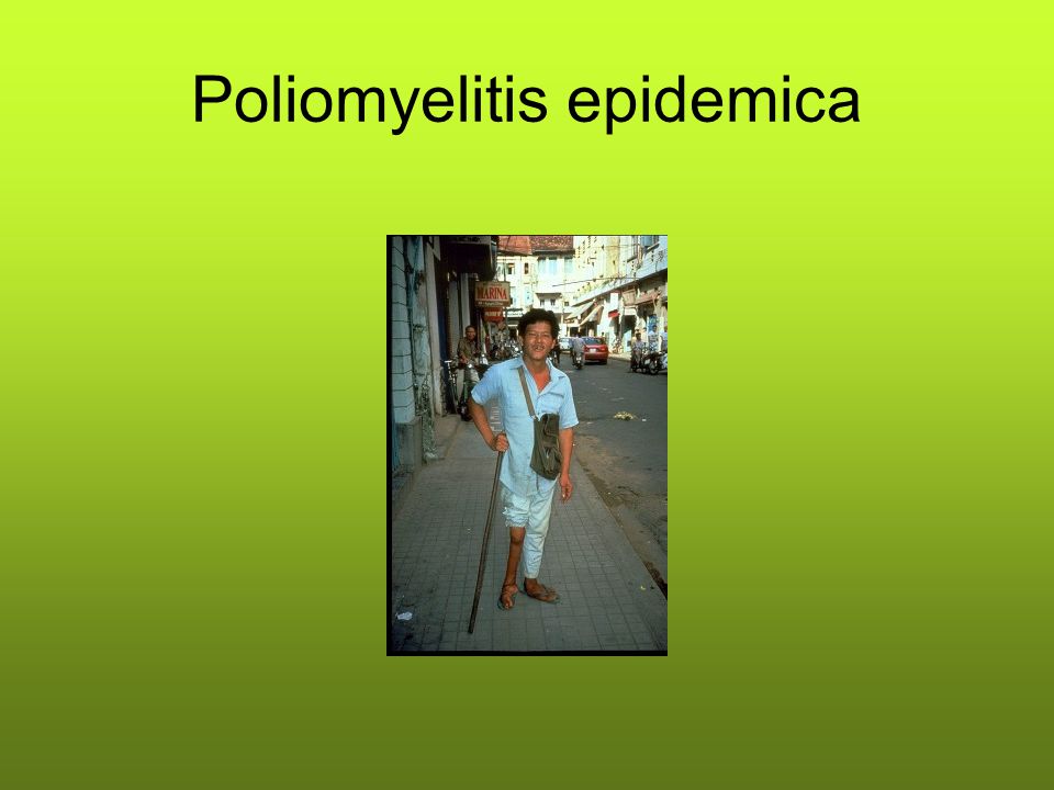Poliomyelitis epidemica