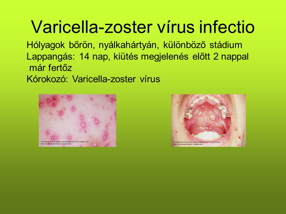 Varicella-zoster vírus infectio