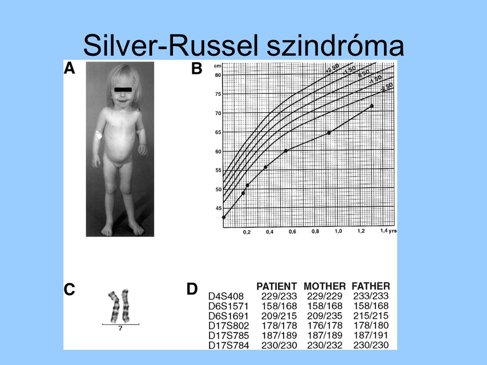 Silver-Russel szindróma
