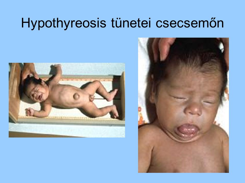 Hypothyreosis tünetei csecsemőn