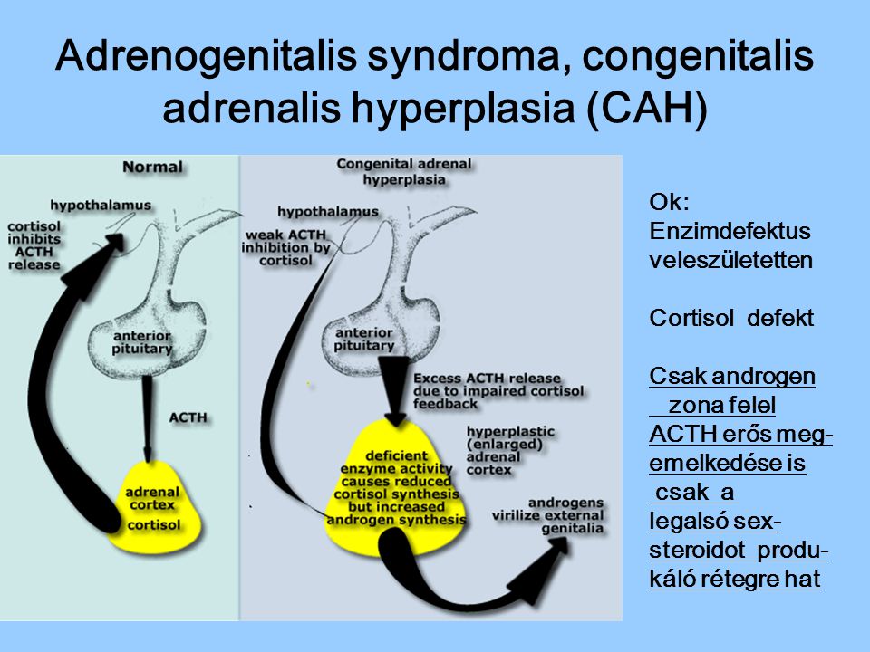 Adrenogenitalis syndroma, congenitalis adrenalis hyperplasia (CAH)
