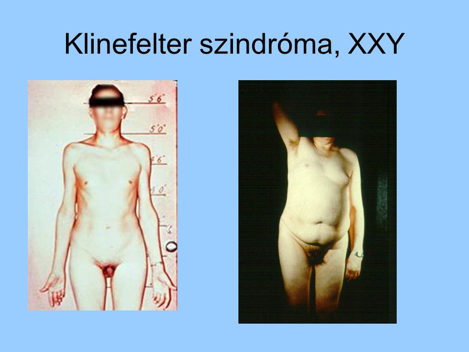 Klinefelter szindróma, XXY