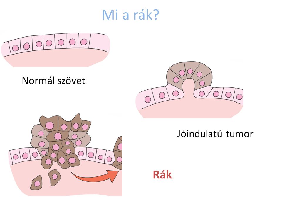Mi a rák Rák Normál szövet Jóindulatú tumor