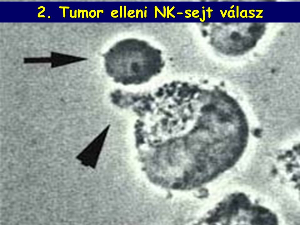 2. Tumor elleni NK-sejt válasz