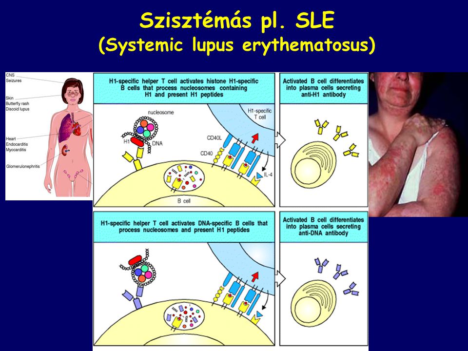 Szisztémás pl. SLE (Systemic lupus erythematosus)