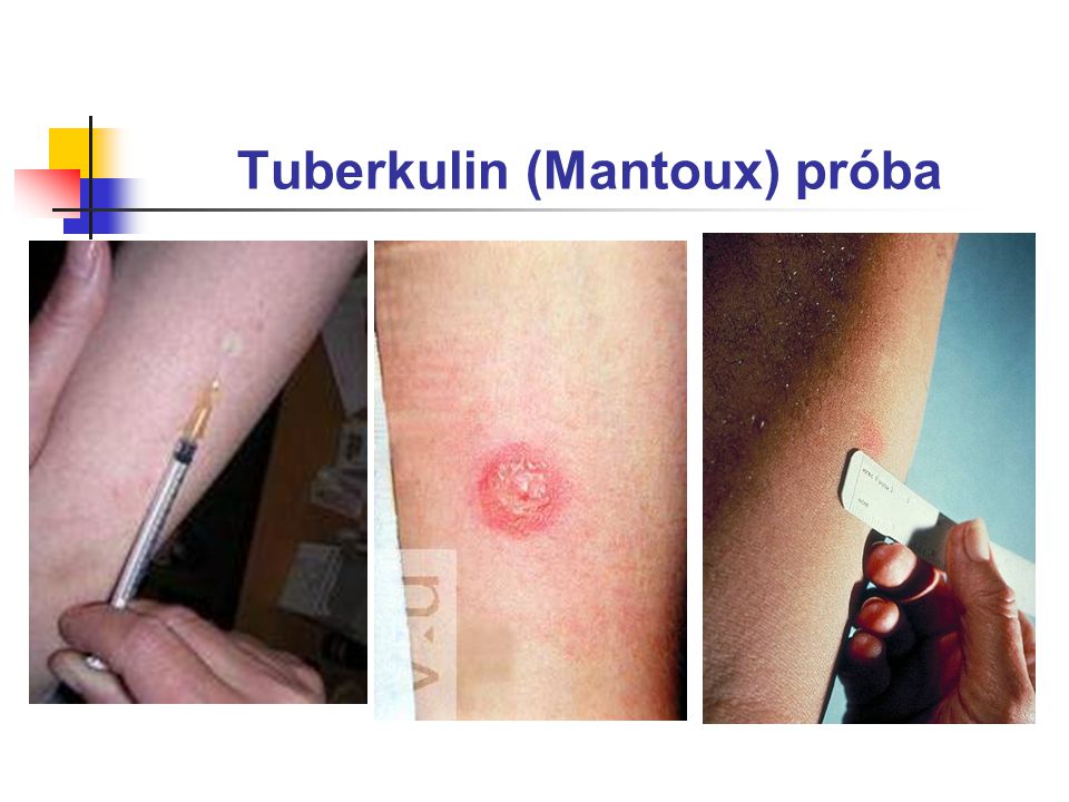 Tuberkulin (Mantoux) próba